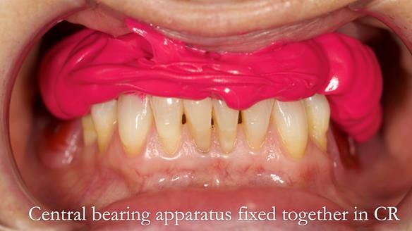 Solving Linda’s Failed “All on 4” implant bridges - full protocol Newsletter 42