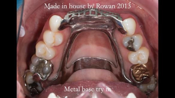 Newsletter 66 Long term case study. Life changing metal based RPD made for Anna