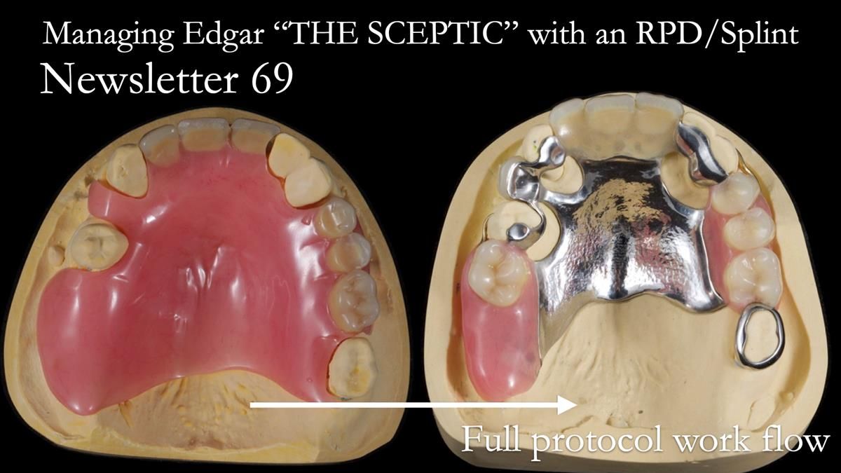 Managing Edgar “THE SCEPTIC” with an RPD/Splint FULL CASE