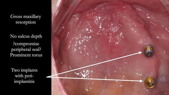 Solving Linda’s Failed “All on 4” implant bridges - full protocol Newsletter 42