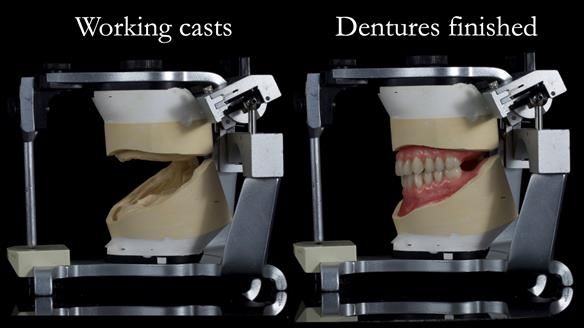 Newsletter 68 Restoring Jan’s Smile: Complete Dentures Inspired by Her Daughter’s Teeth - Post Mouth Surgery