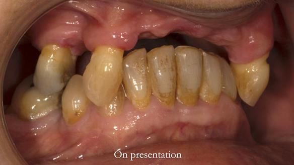 Newsletter 71 Jean’s Class I Mod III RPD: See my mistakes Fractured Mk1 to a Stronger Mk2 RPD (4 years on)