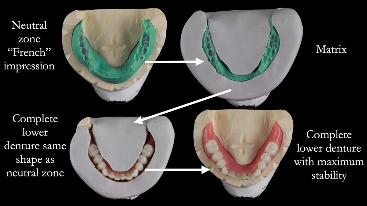 Replacing Madeline’s Complete denture FULL PROTOCOL