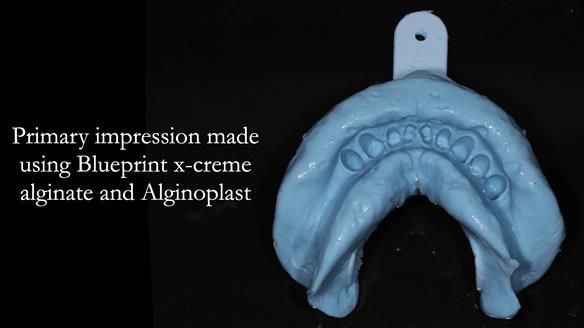 Managing Edgar “THE SCEPTIC” with an RPD/Splint FULL CASE