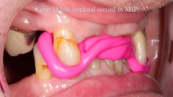 Managing Edgar “THE SCEPTIC” with an RPD/Splint FULL CASE