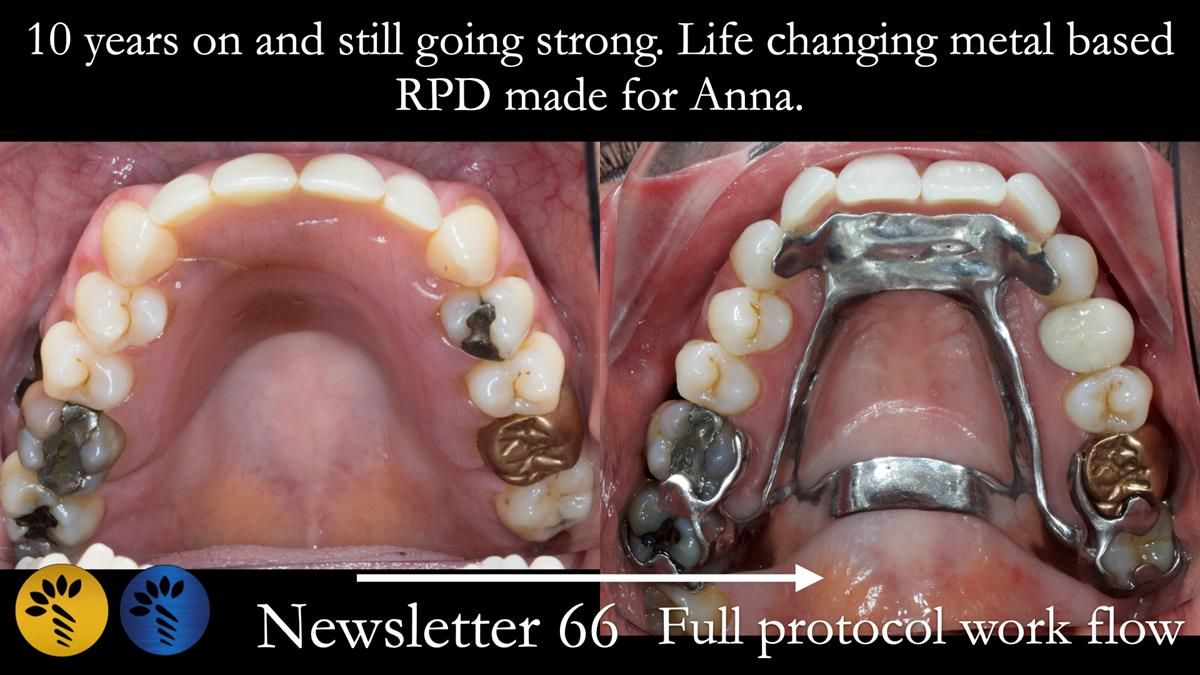 Newsletter 66 Long term case study. Life changing metal based RPD made for Anna