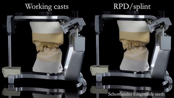 Read Newsletter 67 - Brian's COMBAT DENTURE Case Study