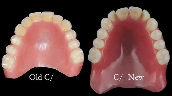 Replacing Madeline’s Complete denture FULL PROTOCOL