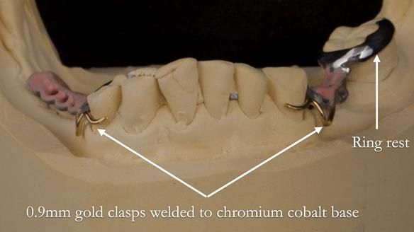 Eileen's transformation with upper and lower RPDs of Scandinavian hygienic design FULL PROTOCOL