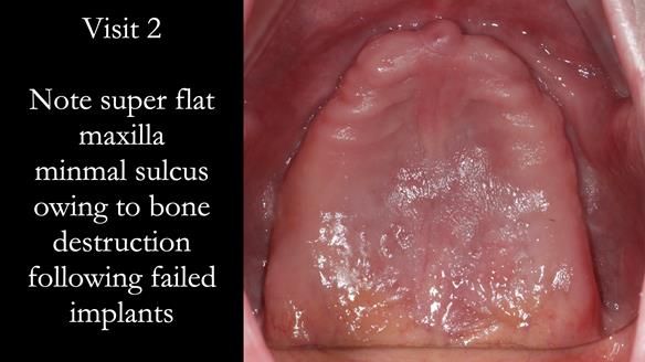 Newsletter 49 Managing Estelle’s failing implants with dentures FULL PROTOCOL