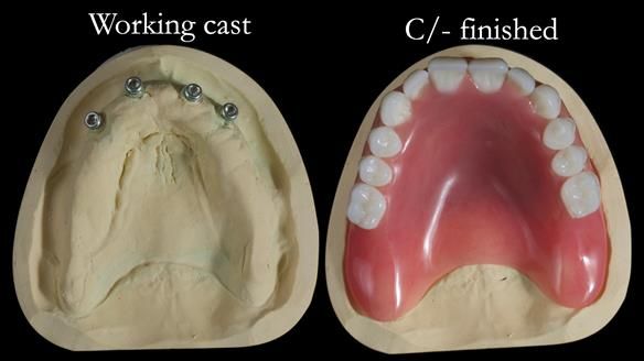 Newsletter 65 Marisa Provision of Complete Dentures on badly placed implants