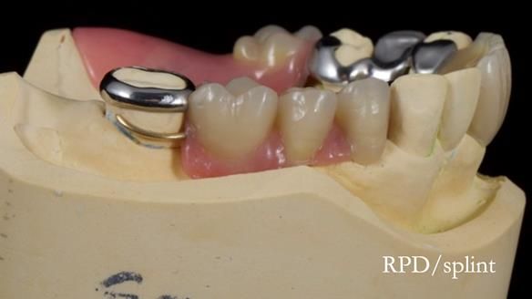 Managing Edgar “THE SCEPTIC” with an RPD/Splint FULL CASE