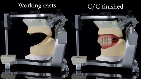 Replacing Madeline’s Complete denture FULL PROTOCOL