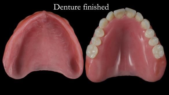 Newsletter 68 Restoring Jan’s Smile: Complete Dentures Inspired by Her Daughter’s Teeth - Post Mouth Surgery