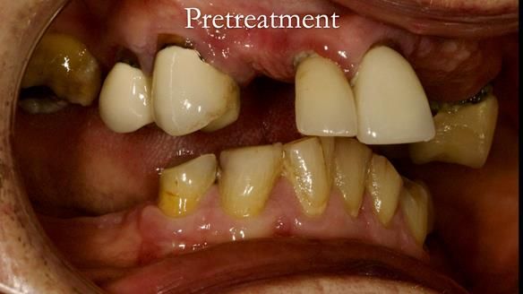 Eileen's transformation with upper and lower RPDs of Scandinavian hygienic design FULL PROTOCOL