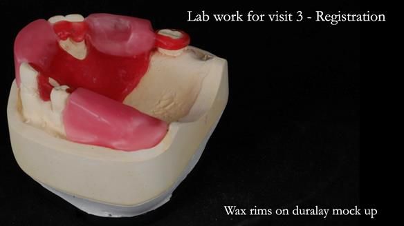 Managing Edgar “THE SCEPTIC” with an RPD/Splint FULL CASE