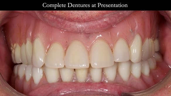 Newsletter 74: Ken’s Case Study Complete Dentures - Life Like and Age Appropriate