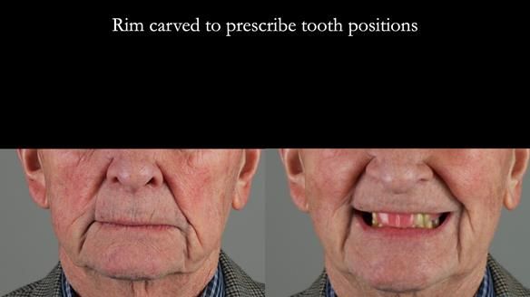 Managing Edgar “THE SCEPTIC” with an RPD/Splint FULL CASE