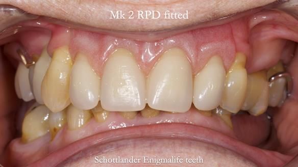 Newsletter 71 Jean’s Class I Mod III RPD: See my mistakes Fractured Mk1 to a Stronger Mk2 RPD (4 years on)