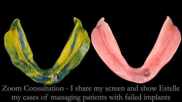 Newsletter 49 Managing Estelle’s failing implants with dentures FULL PROTOCOL