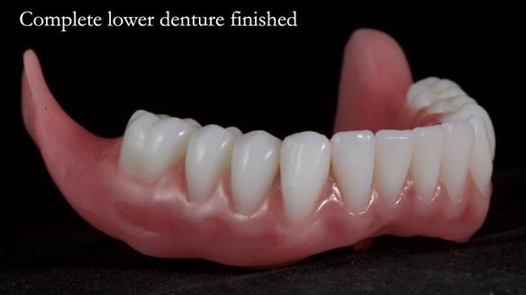 Newsletter 65 Marisa Provision of Complete Dentures on badly placed implants