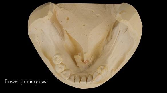 Solving Linda’s Failed “All on 4” implant bridges - full protocol Newsletter 42