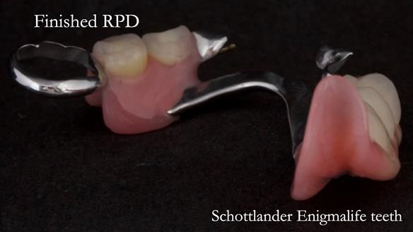 Eileen's transformation with upper and lower RPDs of Scandinavian hygienic design FULL PROTOCOL