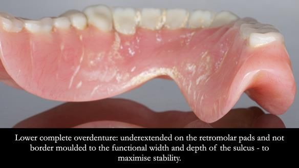 Newsletter 74: Ken’s Case Study Complete Dentures - Life Like and Age Appropriate