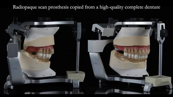 Newsletter 70 Complete Denture Treatment for Kate: A Case Study on Natural-Looking Dentures and Implant-Supported Overdentures