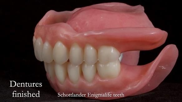 Newsletter 70 Complete Denture Treatment for Kate: A Case Study on Natural-Looking Dentures and Implant-Supported Overdentures