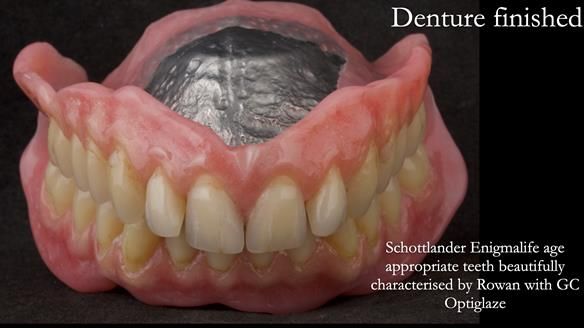 Newsletter 74: Ken’s Case Study Complete Dentures - Life Like and Age Appropriate