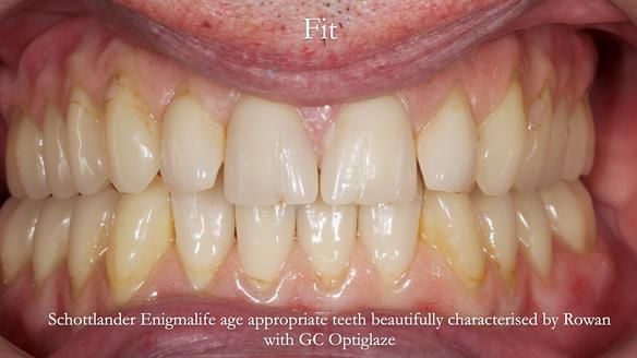 Newsletter 74: Ken’s Case Study Complete Dentures - Life Like and Age Appropriate