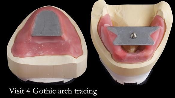 Newsletter 49 Managing Estelle’s failing implants with dentures FULL PROTOCOL