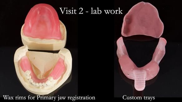 Solving Linda’s Failed “All on 4” implant bridges - full protocol Newsletter 42