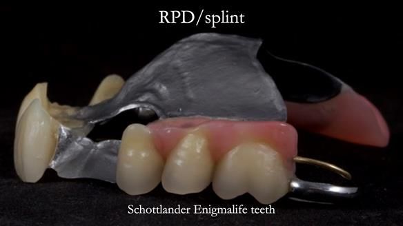 Managing Edgar “THE SCEPTIC” with an RPD/Splint FULL CASE