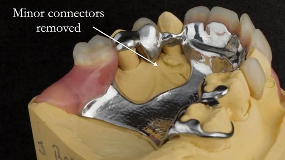 Newsletter 71 Jean’s Class I Mod III RPD: See my mistakes Fractured Mk1 to a Stronger Mk2 RPD (4 years on)