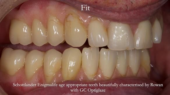 Newsletter 74: Ken’s Case Study Complete Dentures - Life Like and Age Appropriate