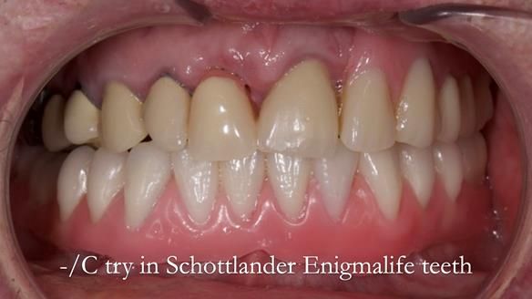 Newsletter 44 - extreme removable prosthodontics – engineering a super-strong and ultra-thin over denture