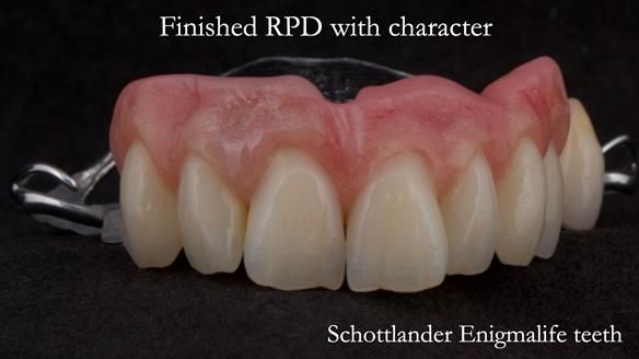 Eileen's transformation with upper and lower RPDs of Scandinavian hygienic design FULL PROTOCOL