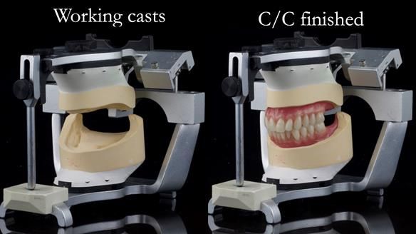 Replacing Madeline’s Complete denture FULL PROTOCOL