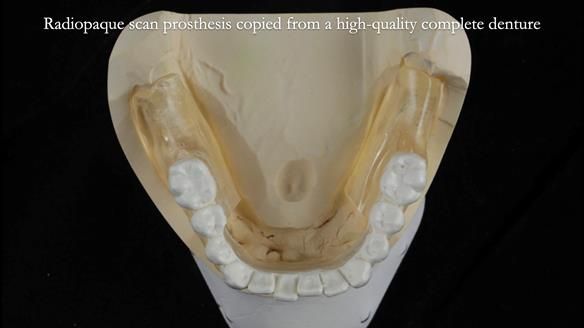 Newsletter 70 Complete Denture Treatment for Kate: A Case Study on Natural-Looking Dentures and Implant-Supported Overdentures