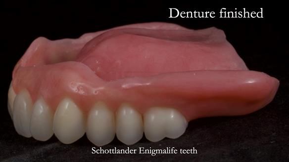 Newsletter 70 Complete Denture Treatment for Kate: A Case Study on Natural-Looking Dentures and Implant-Supported Overdentures