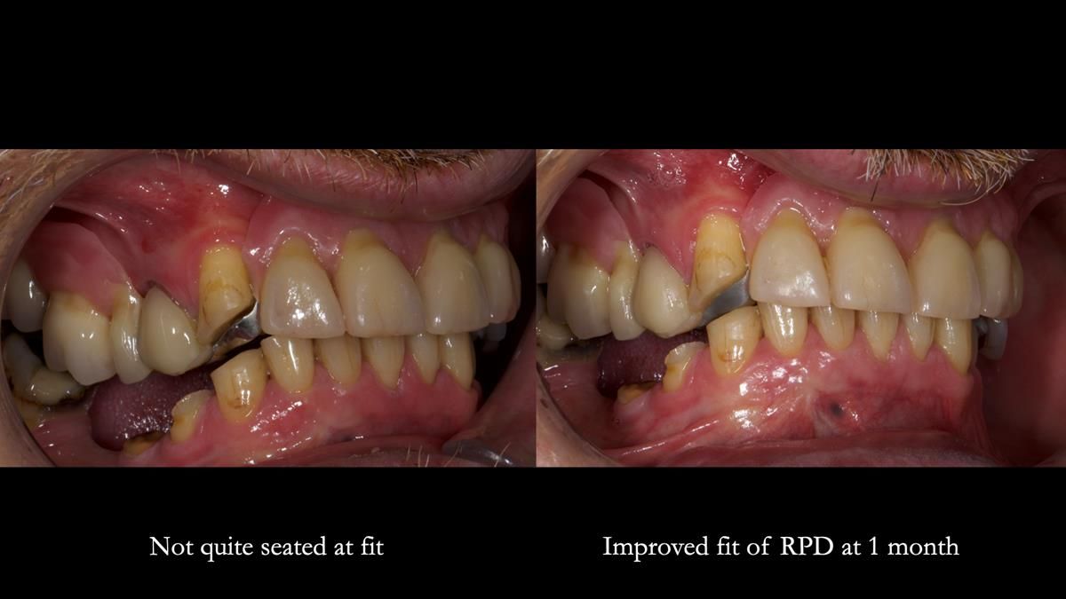 How Keith’s combat denture transformed his life – Newsletter 73