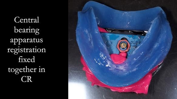 Newsletter 68 Restoring Jan’s Smile: Complete Dentures Inspired by Her Daughter’s Teeth - Post Mouth Surgery