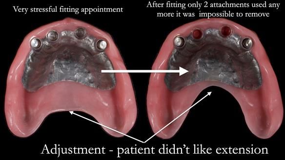 Newsletter 65 Marisa Provision of Complete Dentures on badly placed implants