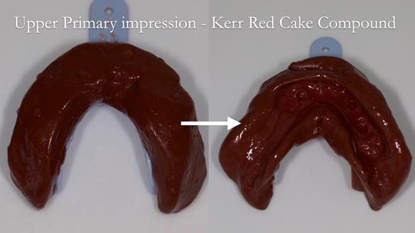 Newsletter 44 - extreme removable prosthodontics – engineering a super-strong and ultra-thin over denture