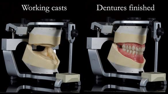 Newsletter 68 Restoring Jan’s Smile: Complete Dentures Inspired by Her Daughter’s Teeth - Post Mouth Surgery