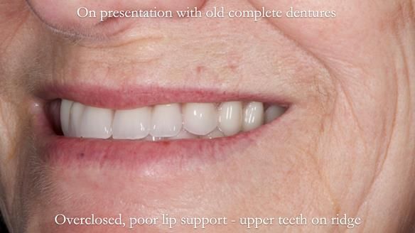 Newsletter 70 Complete Denture Treatment for Kate: A Case Study on Natural-Looking Dentures and Implant-Supported Overdentures