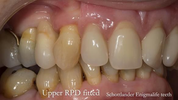 Newsletter 71 Jean’s Class I Mod III RPD: See my mistakes Fractured Mk1 to a Stronger Mk2 RPD (4 years on)