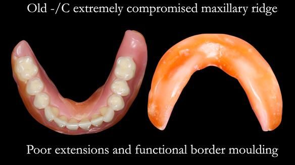 Replacing Madeline’s Complete denture FULL PROTOCOL